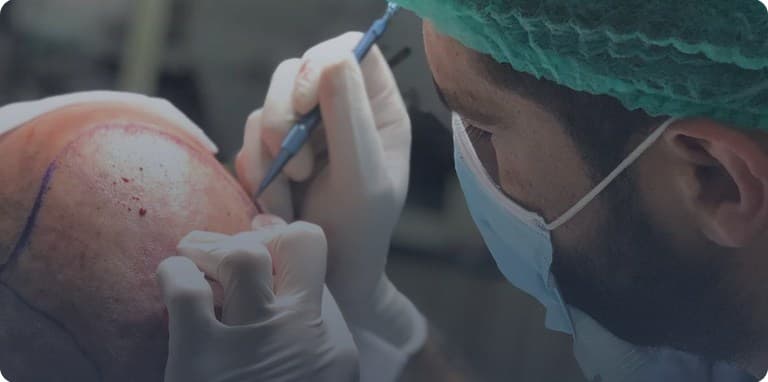 Hair Transplant (FUE & DHI)
