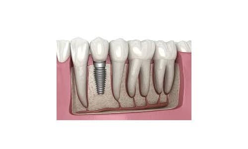 Dental Implants Abroad: Save Thousands on Your New Smile